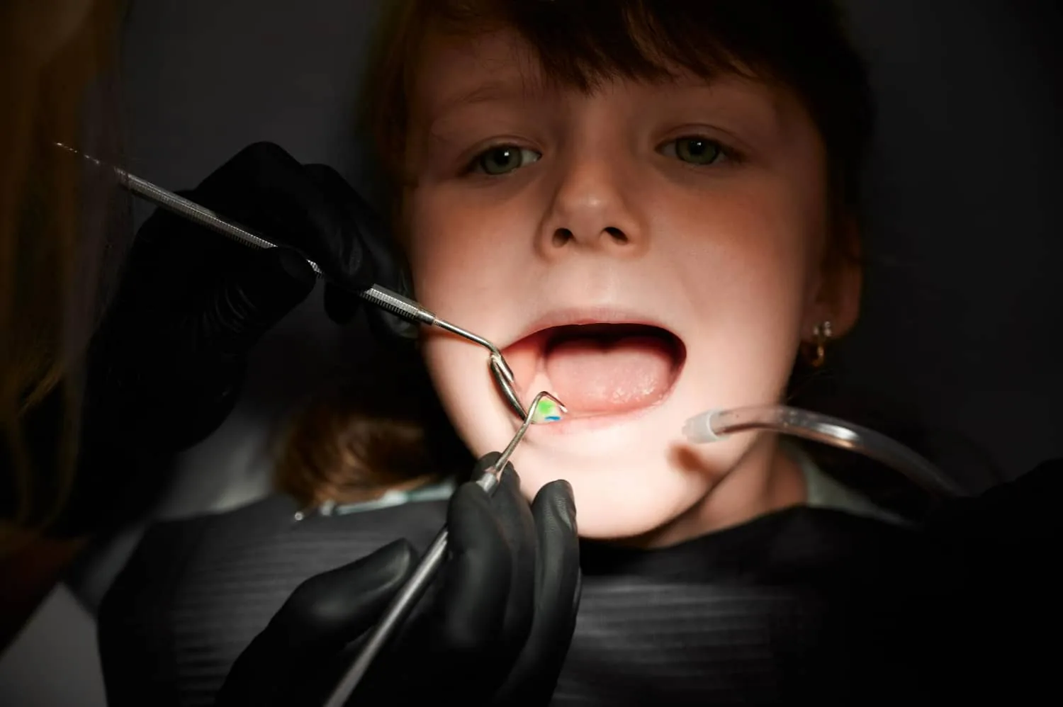 Illustration for What Happens When Pediatric Dental Fillings Are Delayed.