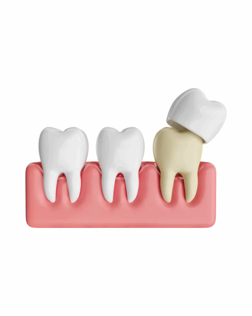 Illustration for Pediatric Crowns: Protecting Your Child's Tooth Until the Adult Tooth Arrives.